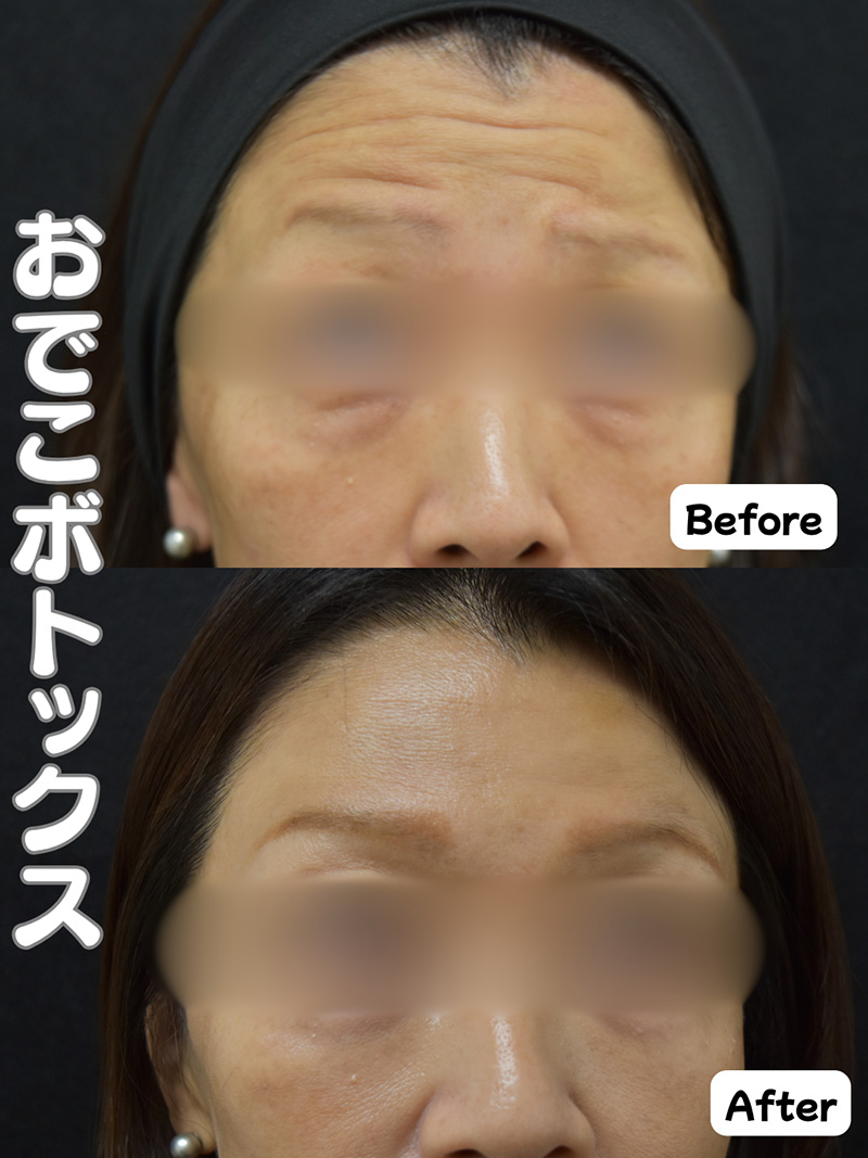 【画像】ボトックス注射 おでこ症例写真