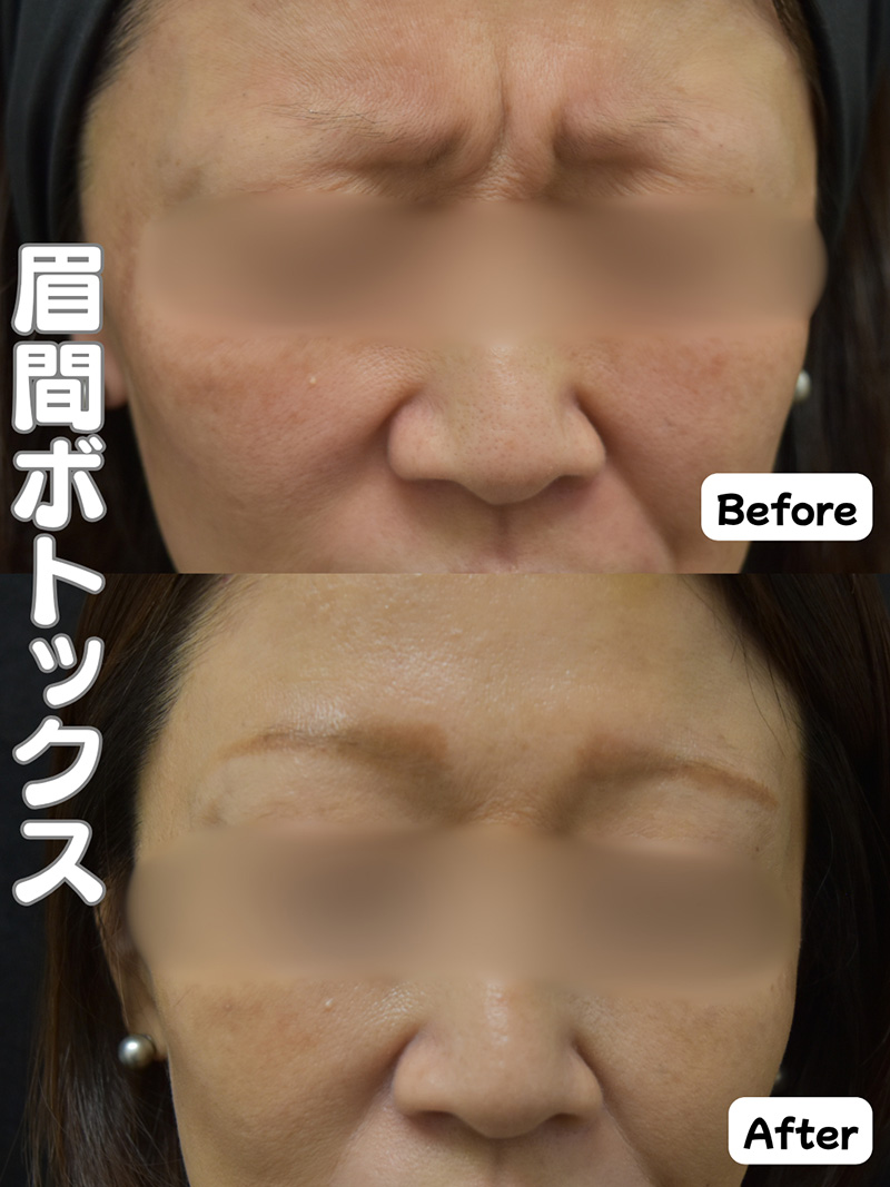 【画像】ボトックス注射 眉間症例写真